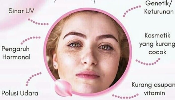 Timbul Flek Meski Jarang Terpapar Matahari.