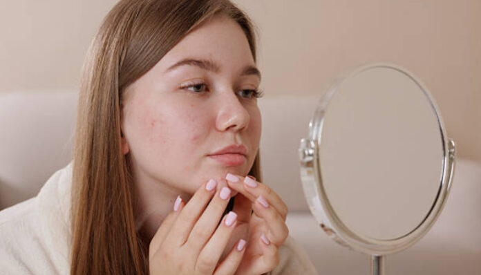 Ilustrasi wanita yang breakout (Foto/iStockphoto)
